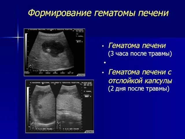 Формирование гематомы печени Гематома печени (3 часа после травмы) Гематома печени