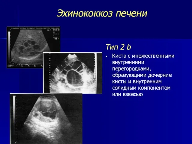 Эхинококкоз печени Тип 2 b Киста с множественными внутренними перегородками, образующими