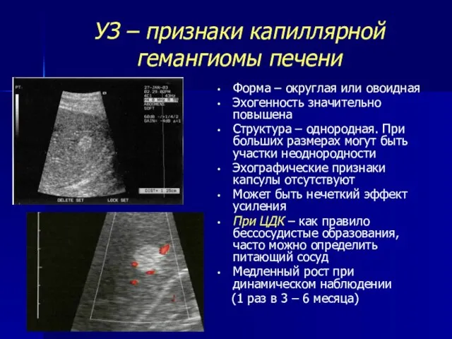 УЗ – признаки капиллярной гемангиомы печени Форма – округлая или овоидная