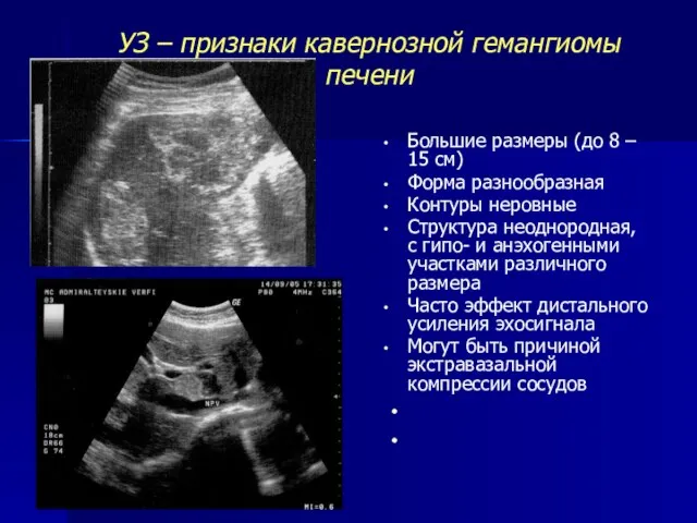 УЗ – признаки кавернозной гемангиомы печени Большие размеры (до 8 –