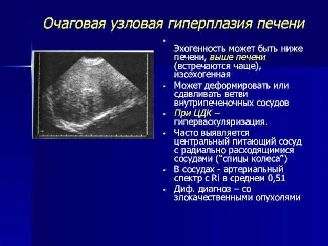 Очаговая узловая гиперплазия печени Эхогенность может быть ниже печени, выше печени