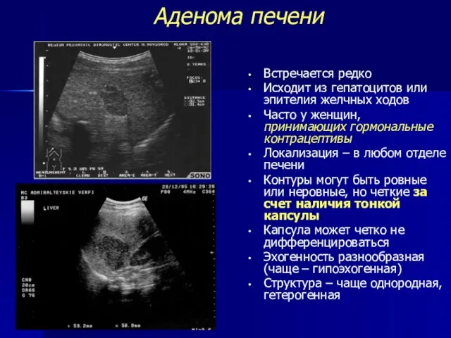 Аденома печени Встречается редко Исходит из гепатоцитов или эпителия желчных ходов