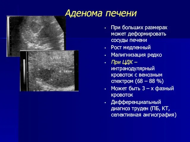 Аденома печени При больших размерах может деформировать сосуды печени Рост медленный