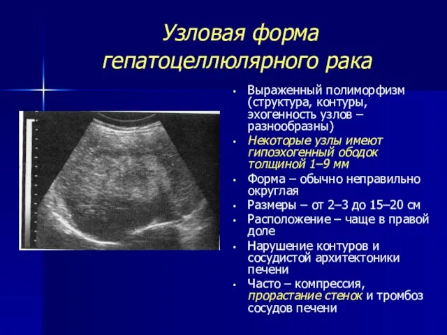 Узловая форма гепатоцеллюлярного рака Выраженный полиморфизм (структура, контуры, эхогенность узлов –