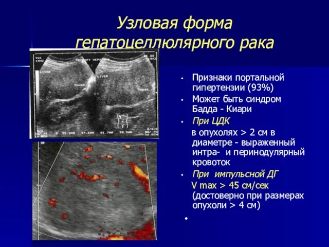 Узловая форма гепатоцеллюлярного рака Признаки портальной гипертензии (93%) Может быть синдром