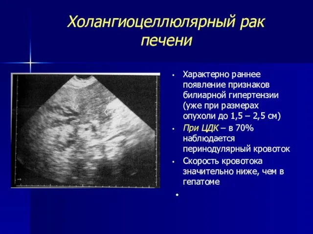 Холангиоцеллюлярный рак печени Характерно раннее появление признаков билиарной гипертензии (уже при