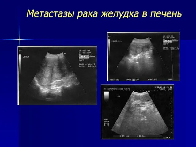 Метастазы рака желудка в печень