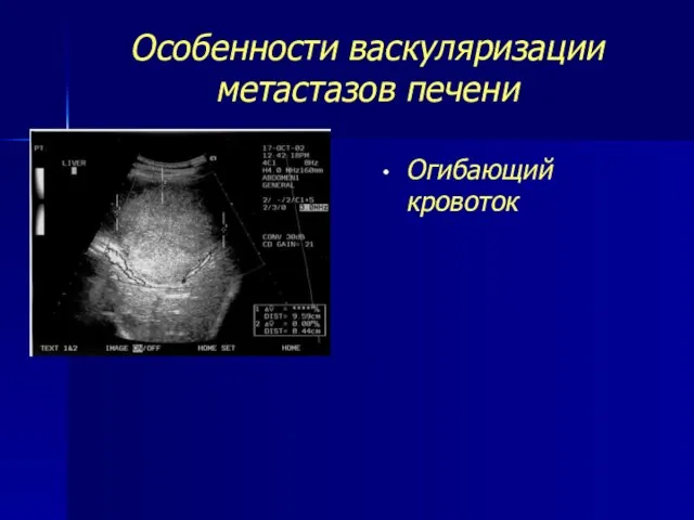 Особенности васкуляризации метастазов печени Огибающий кровоток