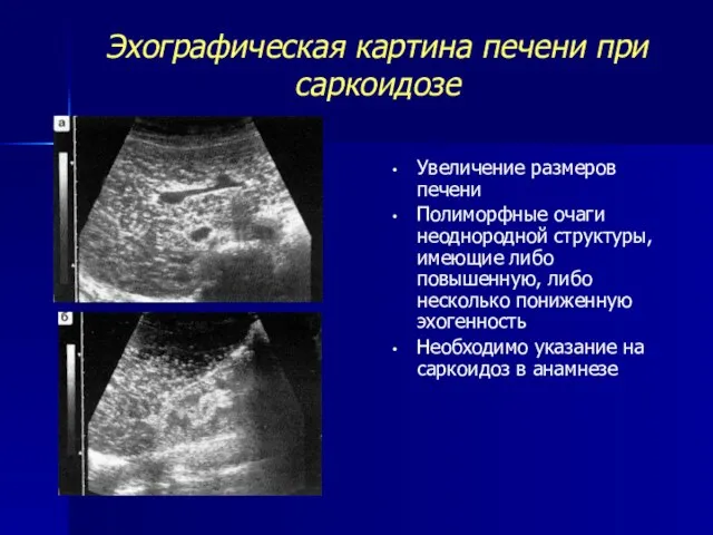 Эхографическая картина печени при саркоидозе Увеличение размеров печени Полиморфные очаги неоднородной