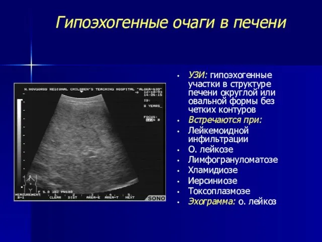 Гипоэхогенные очаги в печени УЗИ: гипоэхогенные участки в структуре печени округлой