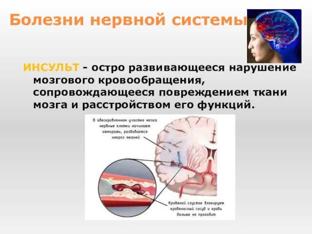 ИНСУЛЬТ - остро развивающееся нарушение мозгового кровообращения, сопровождающееся повреждением ткани мозга