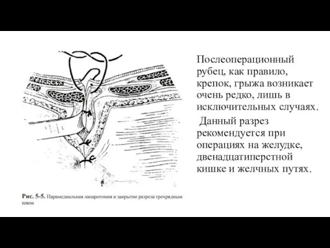 Послеоперационный рубец, как правило, крепок, грыжа возникает очень редко, лишь в