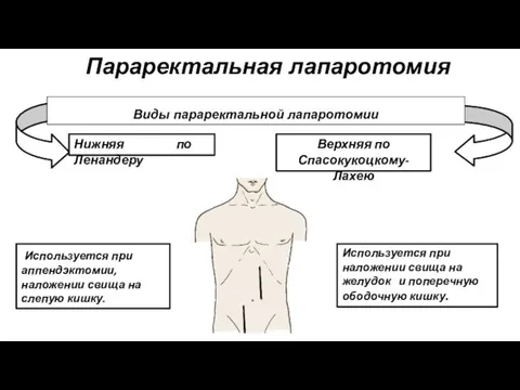 Виды параректальной лапаротомии Верхняя по Спасокукоцкому-Лахею Нижняя по Ленандеру Используется при