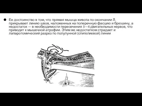 Ее достоинство в том, что прямая мышца живота по окончании Л.