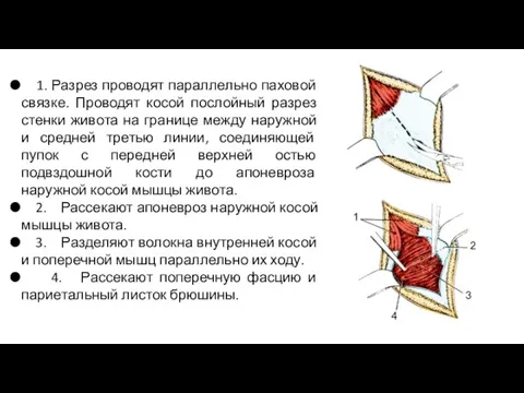 1. Разрез проводят параллельно паховой связке. Проводят косой послойный разрез стенки