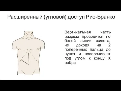 Расширенный (угловой) доступ Рио-Бранко Вертикальная часть разреза проводится по белой линии