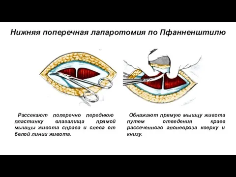 Нижняя поперечная лапаротомия по Пфанненштилю Рассекают поперечно переднюю пластинку влагалища прямой