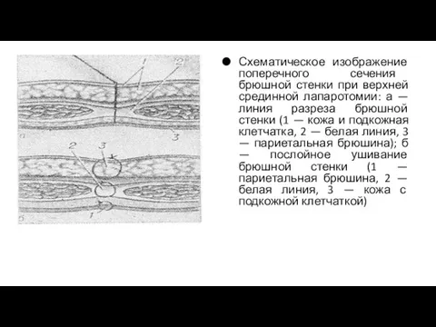 Схематическое изображение поперечного сечения брюшной стенки при верхней срединной лапаротомии: а