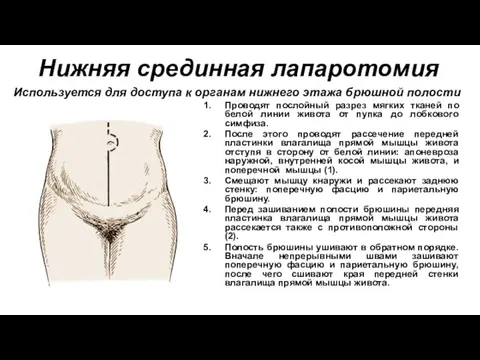 Нижняя срединная лапаротомия Проводят послойный разрез мягких тканей по белой линии