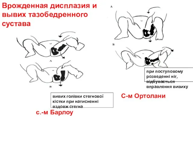 с.-м Барлоу С-м Ортолани Врожденная дисплазия и вывих тазобедренного сустава