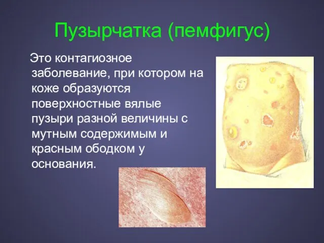 Пузырчатка (пемфигус) Это контагиозное заболевание, при котором на коже образуются поверхностные