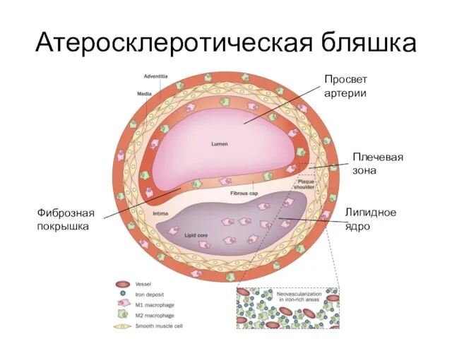 Атеросклеротическая бляшка Липидное ядро Просвет артерии Плечевая зона Фиброзная покрышка
