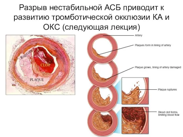 Разрыв нестабильной АСБ приводит к развитию тромботической окклюзии КА и ОКС (следующая лекция)