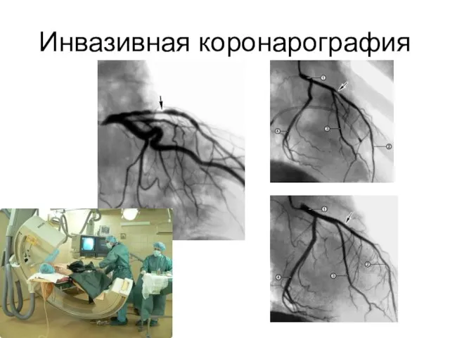 Инвазивная коронарография