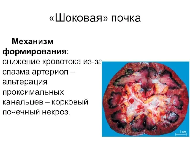 «Шоковая» почка Механизм формирования: снижение кровотока из-за спазма артериол – альтерация