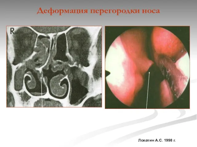 Деформация перегородки носа Лопатин А.С. 1998 г.