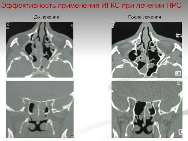 Эффективность применения ИГКС при лечении ПРС После лечения До лечения