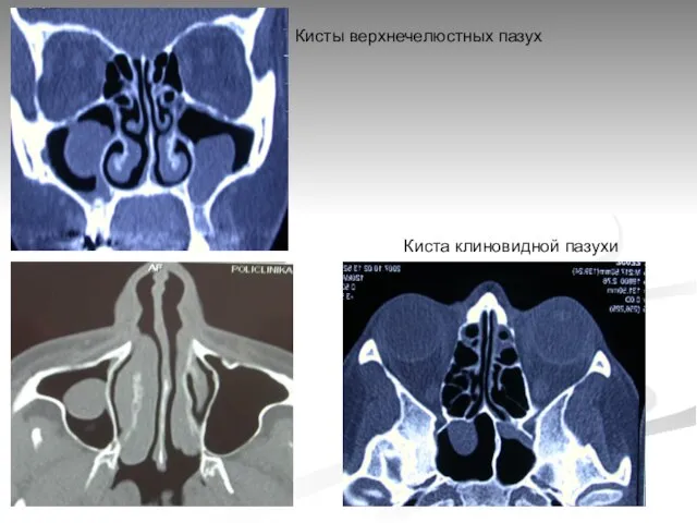 Киста клиновидной пазухи Кисты верхнечелюстных пазух