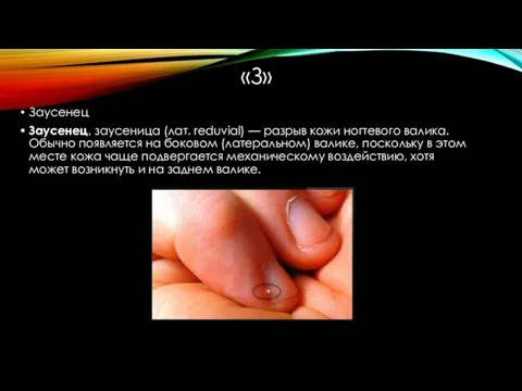 «З» Заусенец Заусенец, заусеница (лат. reduvial) — разрыв кожи ногтевого валика.