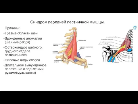 Синдром передней лестничной мышцы. Причины: Травма области шеи Врожденные аномалии(шейные ребра)