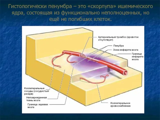 Гистологически пенумбра – это «скорлупа» ишемического ядра, состоящая из функционально неполноценных, но ещё не погибших клеток.