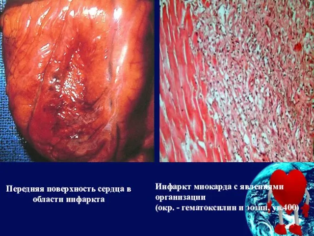 Передняя поверхность сердца в области инфаркта Инфаркт миокарда с явлениями организации
