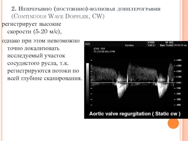 2. Непрерывно (постоянно)-волновая допплерография (Continuous Wave Doppler, CW) регистрирует высокие скорости