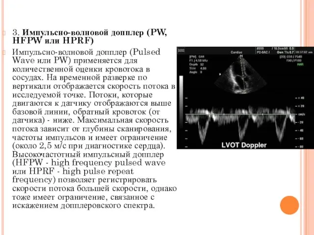 3. Импульсно-волновой допплер (PW, HFPW или HPRF) Импульсно-волновой допплер (Pulsed Wave