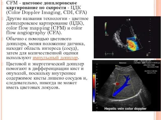 CFM - цветовое допплеровское картирование по скорости - ЦДК (Color Doppler