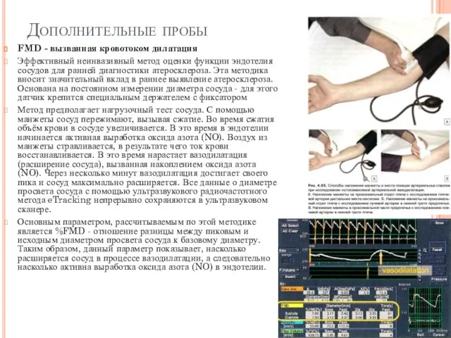 Дополнительные пробы FMD - вызванная кровотоком дилатация Эффективный неинвазивный метод оценки