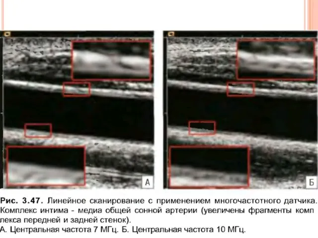 Артерии и вены Картинка артерии – 3 слоя Вена – 1 слой