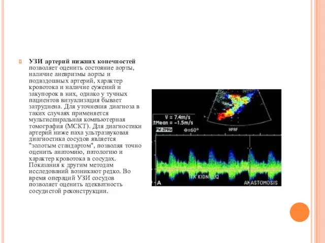 УЗИ артерий нижних конечностей позволяет оценить состояние аорты, наличие аневризмы аорты