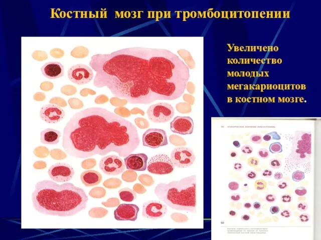 Костный мозг при тромбоцитопении Увеличено количество молодых мегакариоцитов в костном мозге.