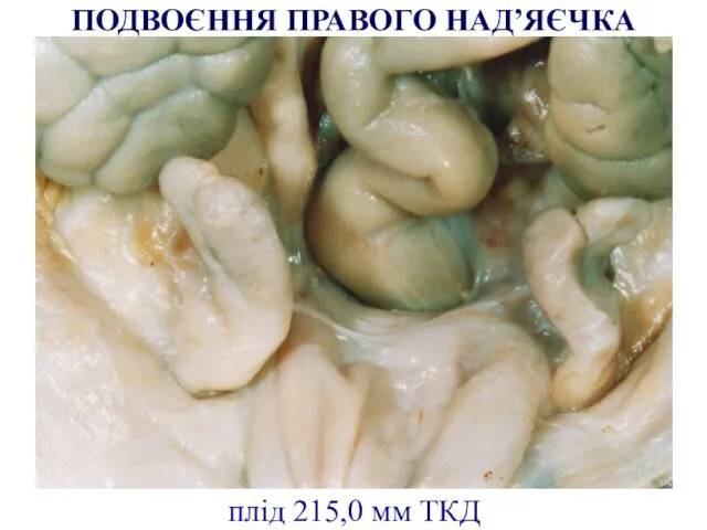 плід 215,0 мм ТКД ПОДВОЄННЯ ПРАВОГО НАД’ЯЄЧКА