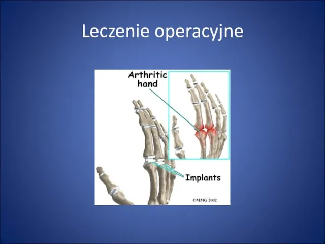 Leczenie operacyjne