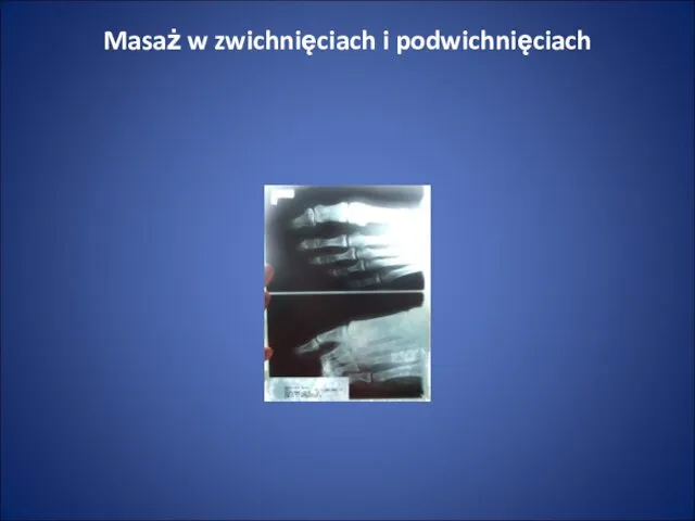 Masaż w zwichnięciach i podwichnięciach