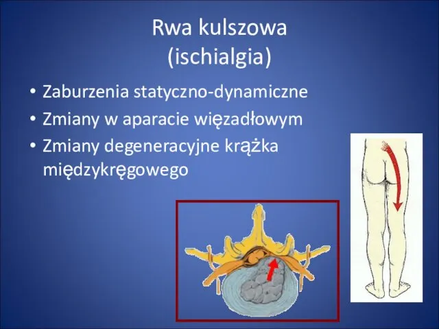 Rwa kulszowa (ischialgia) Zaburzenia statyczno-dynamiczne Zmiany w aparacie więzadłowym Zmiany degeneracyjne krążka międzykręgowego