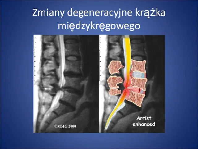 Zmiany degeneracyjne krążka międzykręgowego