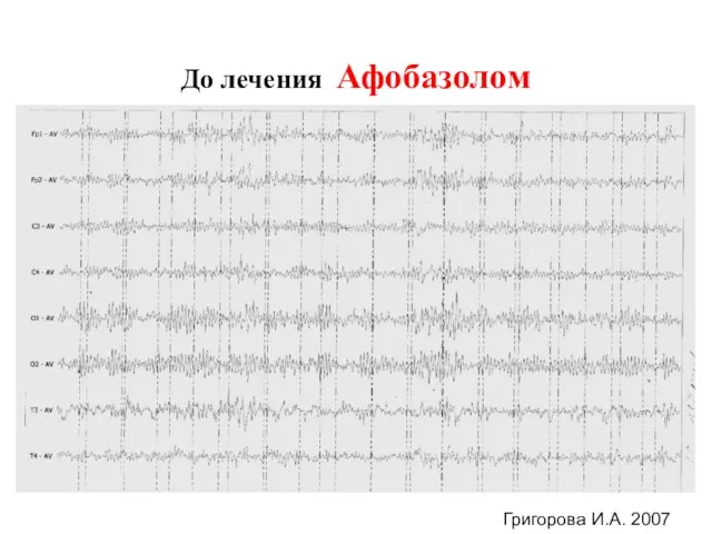 До лечения Афобазолом Григорова И.А. 2007