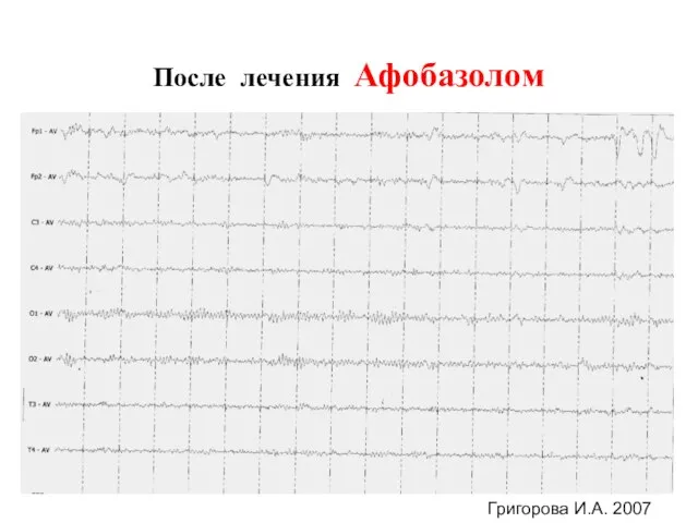 После лечения Афобазолом Григорова И.А. 2007